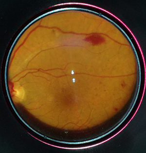Diabetic retinaopathy