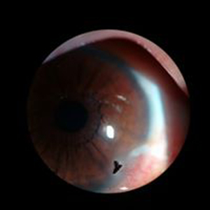 Corneal foreign body