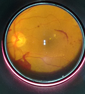 Diabetic retinopathy