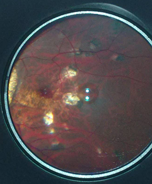 Macular heamorrhage in Myopic eye