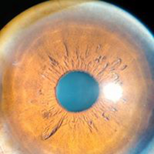 Tangential Diffuse light image of the Anterrior segment of eye